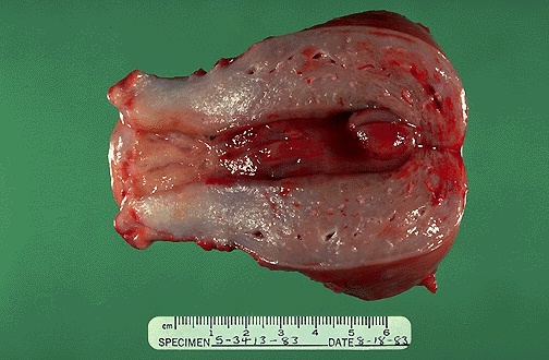 billede af intracavitr polyp